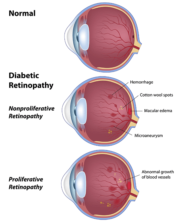 Diabetic Eye Treatment in Sugar Hill