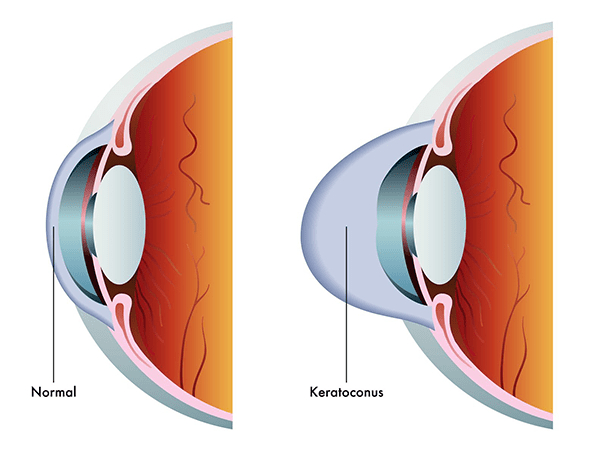 Sugar Hill Distorted Cornea